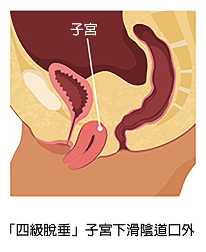 子宮滑出陰道口 七成自然產婦應防子宮脫垂