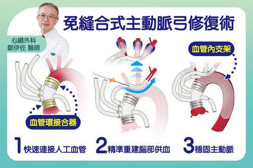 主動脈剝離免縫合 台中慈濟醫院成功率百分百