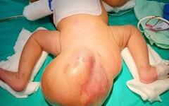 母胎中長腫瘤10週長四倍 女嬰竟帶著16公分「大球」出生