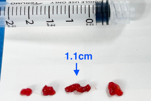14歲童腦中風在教室昏倒 急送醫10分鐘取栓救回大腦