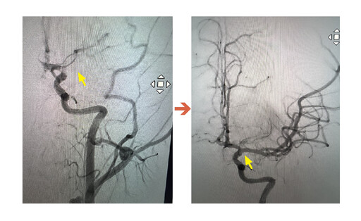 14歲童腦中風在教室昏倒 急送醫10分鐘取栓救回大腦