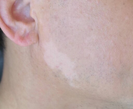 白斑治療新突破 點陣微創表皮移植 皮膚色澤相似達八成