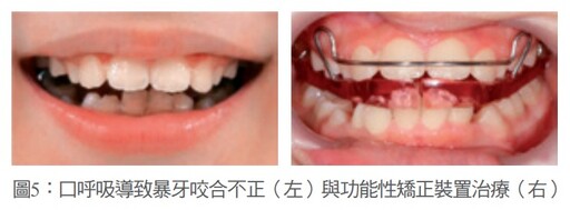 兒童牙科暑假篇 定期檢查牙齒大小事
