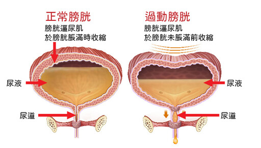 膀胱太過動 害她忙著跑廁所