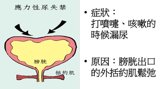 婦女尿失禁的治療