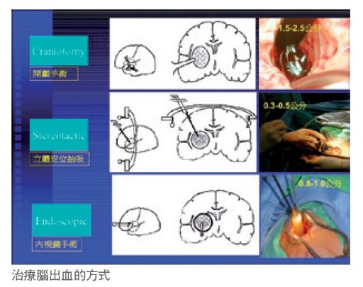 化解腦血管危機 出血性腦中風與毛毛樣腦血管病