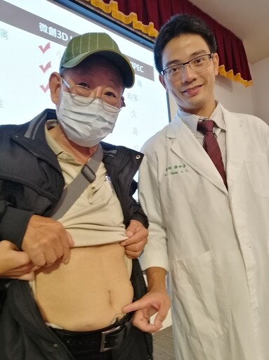 大腸癌腹膜轉移 微創3D手術加腹腔溫熱化療 抗癌更順利