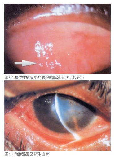 眼睛紅又癢 過敏性結膜炎報到