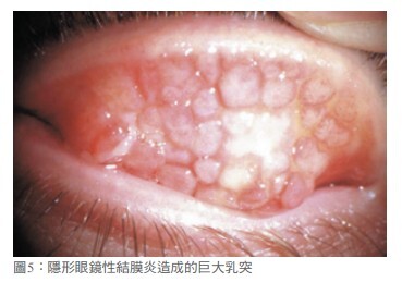 眼睛紅又癢 過敏性結膜炎報到