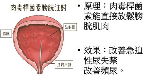 婦女尿失禁的治療