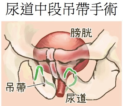 婦女尿失禁的治療