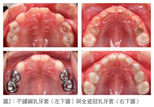 兒童牙科暑假篇 定期檢查牙齒大小事