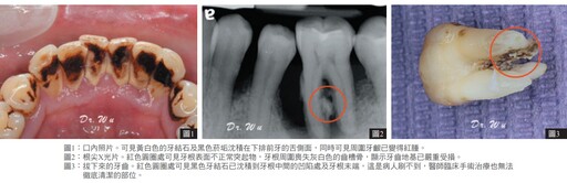 放生牙結石的代價 小心！你未來可能會付出一大桶金