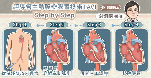 經導管主動脈瓣膜置換術TAVI不是只靠高科技！詳盡術前計畫提高成功率、減少併發症，專科醫師圖文懶人包