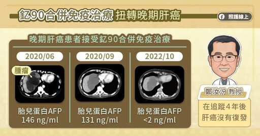 釔-90治療合併免疫治療扭轉晚期肝癌的命運，專科醫師圖文解說