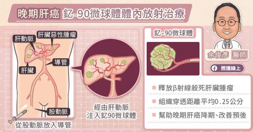 釔-90微球放射治療，幫助晚期肝癌降期、改善預後，專科醫師圖文解說