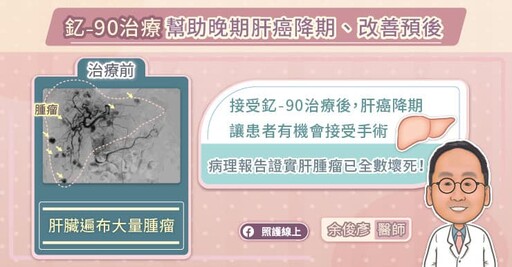 釔-90微球放射治療，幫助晚期肝癌降期、改善預後，專科醫師圖文解說