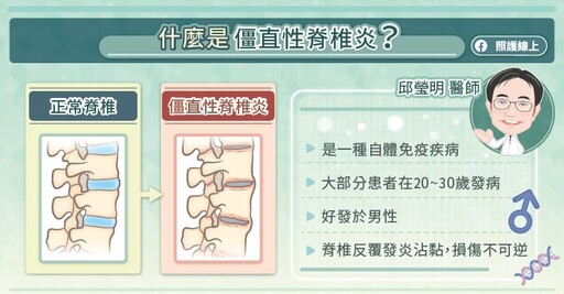 持續背痛三個月,越休息越痛?當心僵直性脊椎炎!免疫風濕專科醫師圖文解說