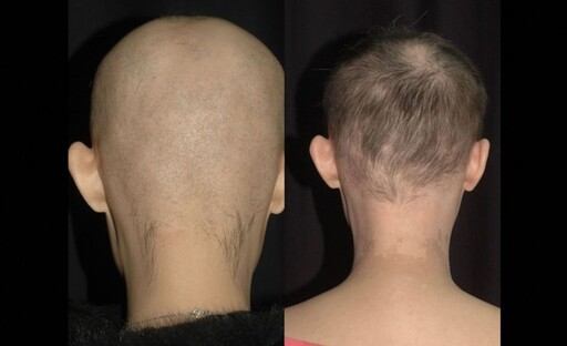 30歲女產後圓禿「後腦剩兩撮毛」 台大醫院研究藥水療法救回一頭秀髮