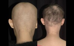 30歲女產後圓禿「後腦剩兩撮毛」 台大醫院研究藥水療法救回一頭秀髮