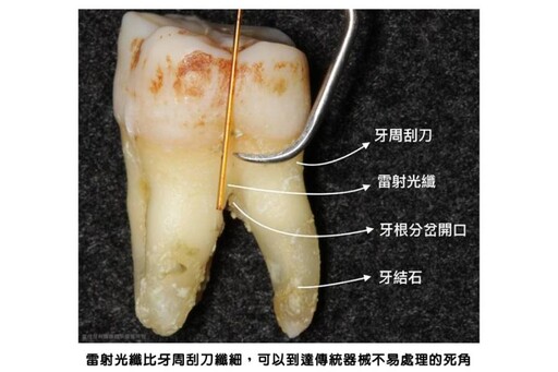 【有影】新式水雷射輔助牙周治療和傳統牙周刮刀治療有何差異？專科醫師結合高科技儀器 看病不必再驚慌