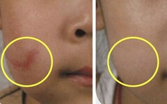 女童摔一跤臉冒「7公分紅疤」 醫出招甩掉疤痕增生！必知傷口護理秘訣