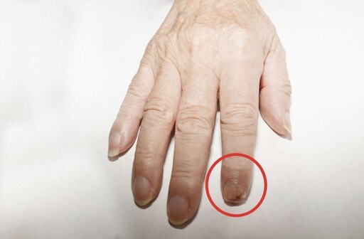 食指指甲又腫又痛數個月 男子竟是皮膚癌長在指甲上！