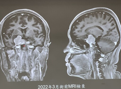 嚇壞！騎車一半「眼前事物全歪斜」 原來4公分腫瘤壓眼險失明