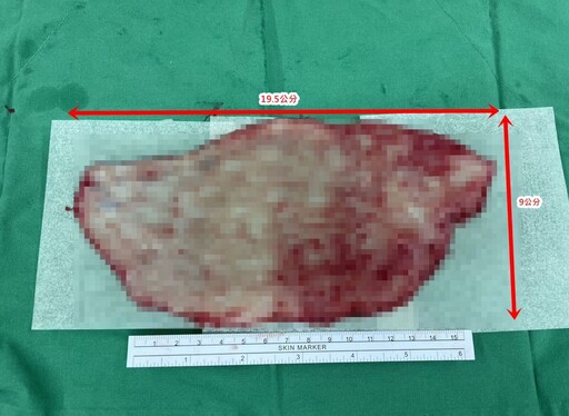 她慘遭機車「掀開整片大腿皮」血肉淋漓！ 醫師巧手種回全層皮膚