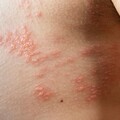 劇痛「帶狀疱疹」竟另類職業傷害？ 壓力爆表者發生率增14%