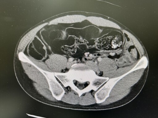 34歲男長期腹脹 全球罕見！竟是「百顆脂肪瘤」害腸道糾成團
