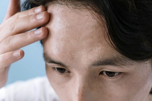 氣溫有感飆升 中醫教你遠離「乏力、皮膚癢、中暑」三大不適