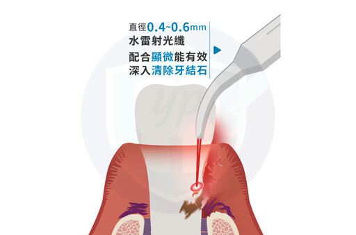 【有影】牙周治療也能微創！水雷射搭顯微鏡掀牙科新風潮