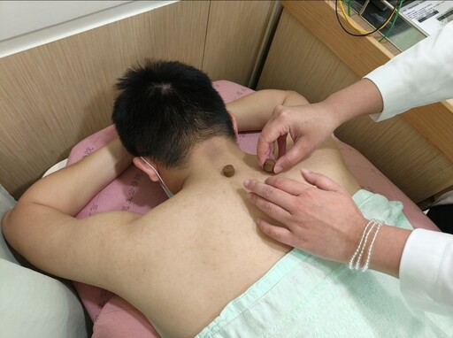 過敏兒瘋冬病夏治三伏貼 中醫：敷出「兩症狀」就不對勁！