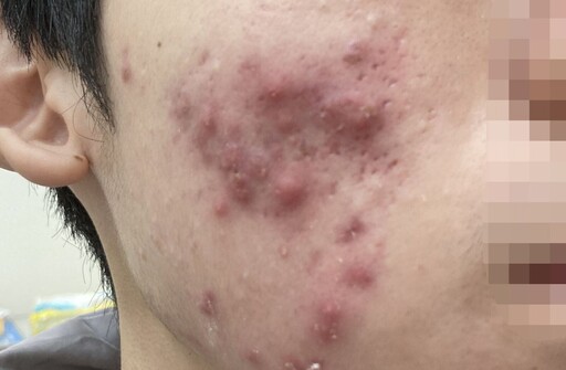 春春痘也分類「這一種」發紅劇痛！ 醫曝黃金治療期少留疤