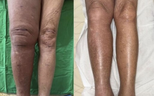 她「一腳水腫3倍大」險長期臥床 醫神手用比髮細縫線吻合血管拆彈