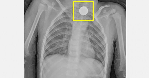 3歲弟喉嚨痛急診…手術2小時夾出「扁平異物」 醫示警：恐害食道破裂
