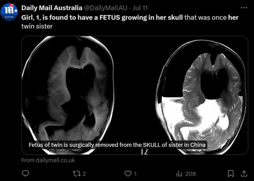 1歲女嬰行動遲緩檢查驚見「大腦寄生胎中胎」 醫生: 胎兒已長出上肢指甲