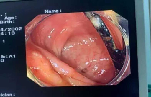 腹痛3個以為腫瘤 廣東男就醫檢查「取出一根叉子」