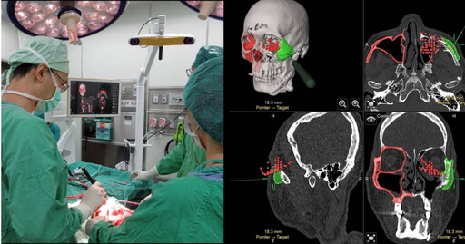 50歲男車禍致顏面不對稱 「精準導航重建」大幅改善