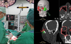 50歲男車禍致顏面不對稱 「精準導航重建」大幅改善