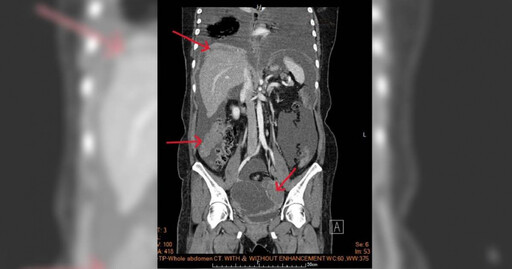 49歲女腹痛竟罹晚期卵巢癌 「手術+熱化學療法」穩定控制