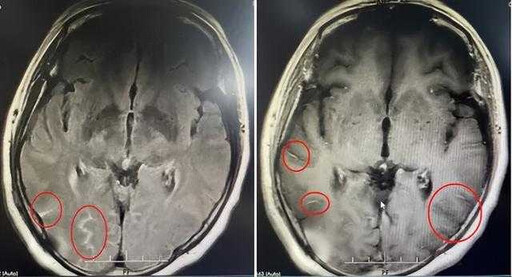 廣東婦頭痛爆炸「確診腦膜炎」 元凶竟是每天買菜…醫示警：死亡率高