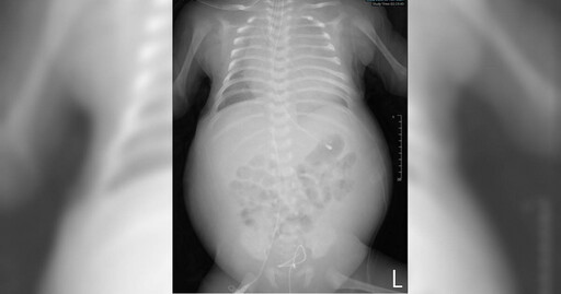 為保險延誤新生兒篩檢 27天大嬰兒險喪命