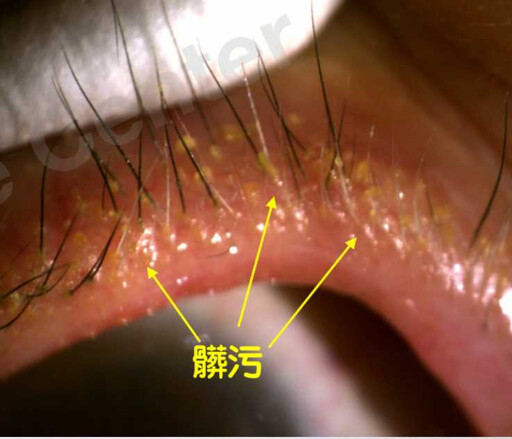 充血癢到受不了！ 醫驚見「毛上11隻蟲蟲在爬」畫面曝 她羞回：都沒洗