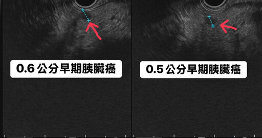 不菸不酒中年男接受健檢 醫師檢查發現2顆超迷你「癌王」