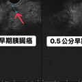 不菸不酒中年男接受健檢 醫師檢查發現2顆超迷你「癌王」