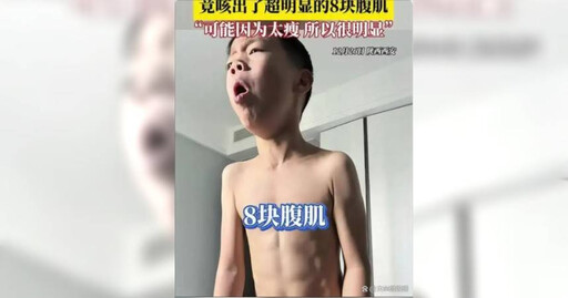 感染流感咳不停！中國7歲男童咳出「巧克力腹肌」 醫師解釋：體脂太低