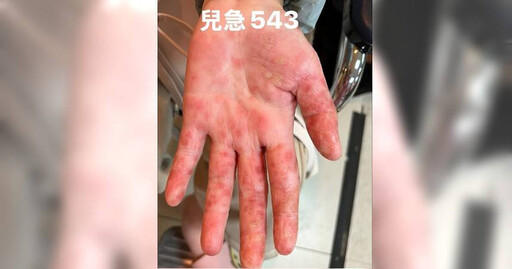 10歲女童全身莫名起疹竟是「腸病毒」 專業醫提醒：非典型手足口病誤診率較高