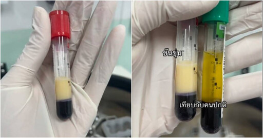 傻眼！男送醫抽出「牛奶血」 醫生示警：愛喝「它」近乎直接喝油